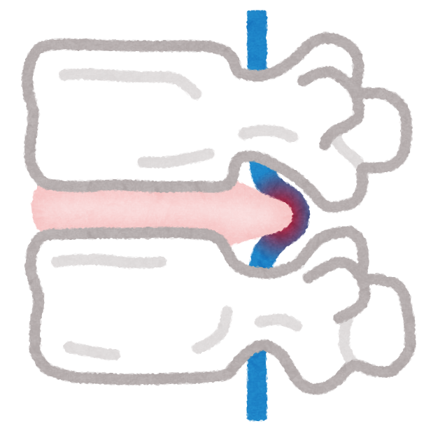 藤井寺市で『腰椎ヘルニア』のお悩みは当院にお任せください！