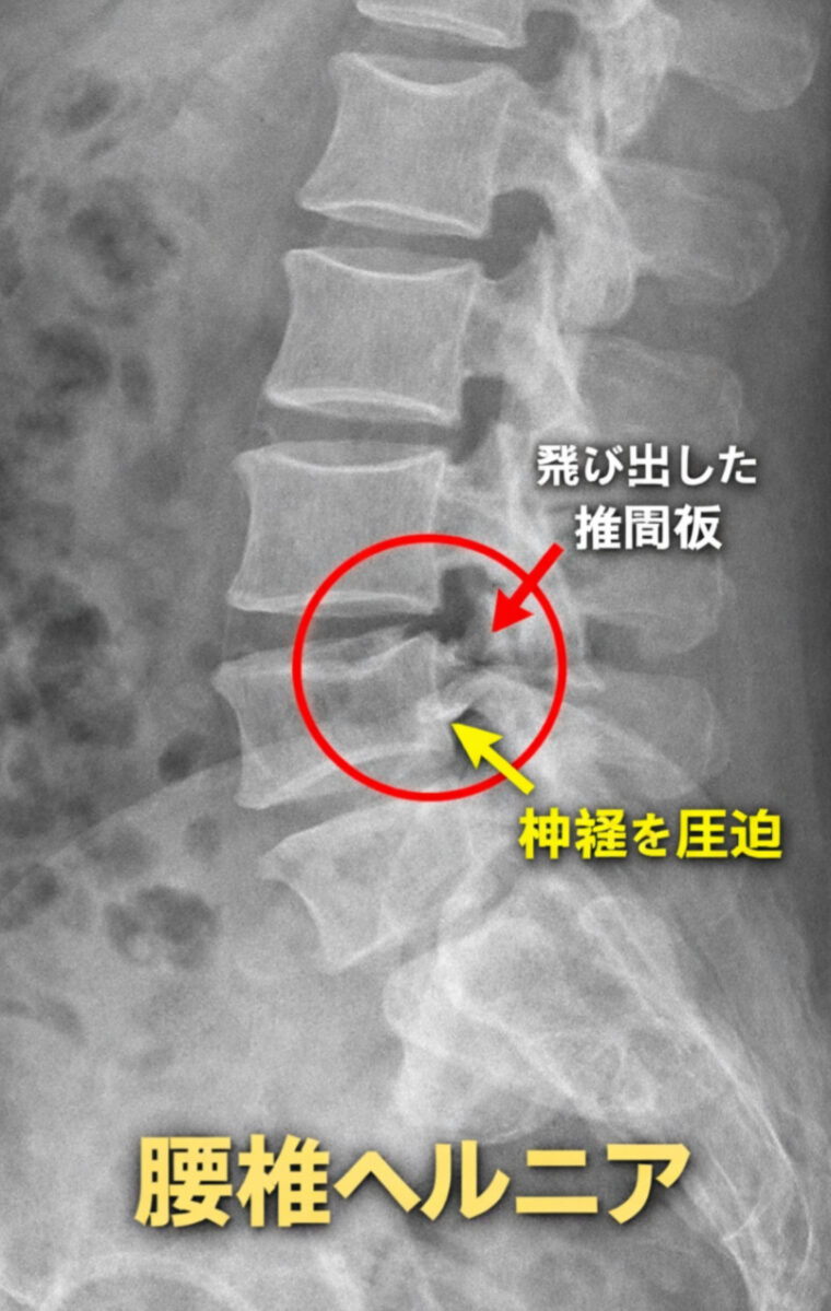 『腰椎ヘルニアは手術しか治す方法ないの？？』