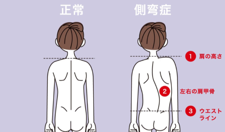 【なぜ10代の女の子に側弯症が多いのか】
